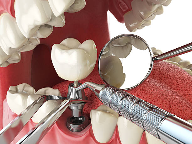 Best Emergency Dentist for Knocked-Out Tooth in Shaker Heights, OH